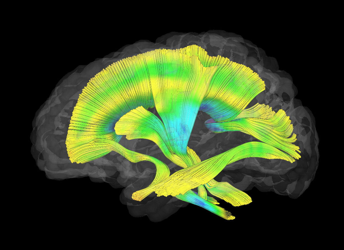 Image of a brain from the fragile X study